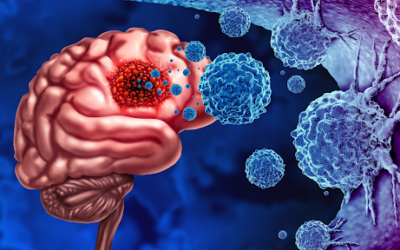 Glioblastoma Immunotherapy: Why Combination Strategies May Hold Promise